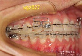 陶瓷托槽 陶瓷托槽