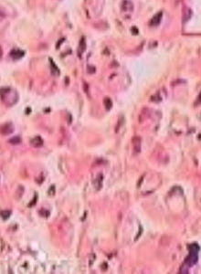 印戒細胞癌 印戒細胞癌