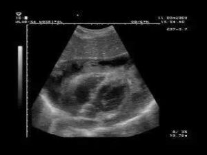 心包積液 心包積液