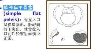 狹窄骨盆 狹窄骨盆