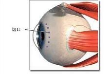 胎患內障 胎患內障