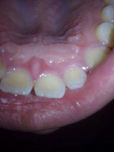 切牙乳頭 切牙乳頭