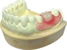 義齒修復 義齒修復