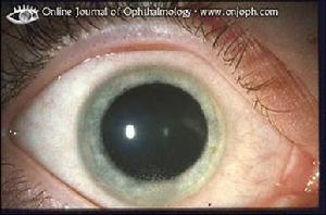 瞳神緊小 瞳神緊小