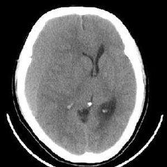 老年性慢性硬膜下血腫
