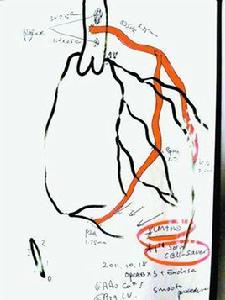 心臟搭橋術 心臟搭橋術