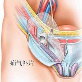 無張力疝修補術 無張力疝修補術