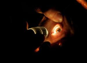 早期白內障 早期白內障