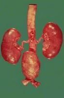 腎動脈粥樣硬化 腎動脈粥樣硬化