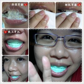 牙齒冷光美白 牙齒冷光美白