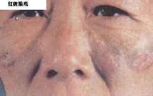 狼瘡胸腹水 狼瘡胸腹水