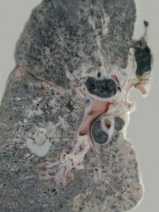 放射性性腺疾病 放射性性腺疾病