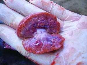 腎動脈血栓形成和栓塞