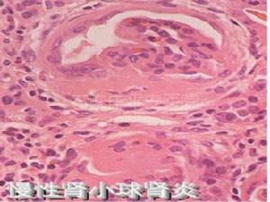 慢性腎小球腎炎