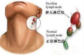 淋巴轉移癌 淋巴轉移癌