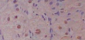 慢性肝炎 慢性肝炎