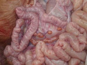 腸系膜淋巴結腫大 腸系膜淋巴結腫大