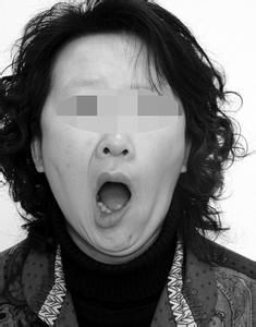 膿耳面癱 膿耳面癱