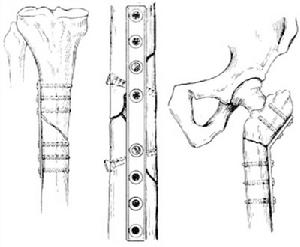 螺釘內固定術 螺釘內固定術