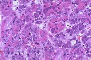 腺垂體功能減退症