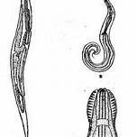 鐵線蟲病 鐵線蟲病