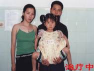 先天性髖關節脫位