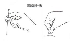 針刺手法