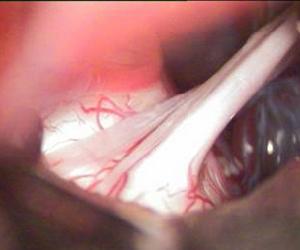 三叉神經根 三叉神經根