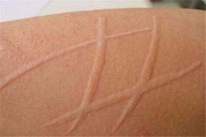 皮膚劃痕蕁麻疹