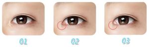 內眼角修復