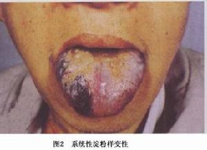 澱粉樣變病和澱粉樣關節病