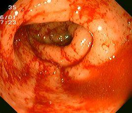 潰瘍性結腸炎 潰瘍性結腸炎