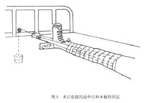 （圖）髖關節結核病