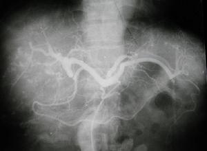 （圖）肝臟惡性血管瘤