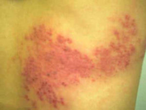 陰莖皰疹 陰莖皰疹