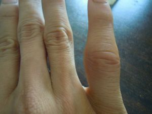 關節腫大 關節腫大