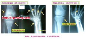 多發性骨骺發育不良