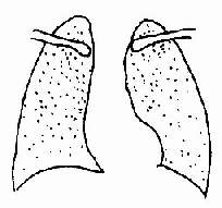 抗胰蛋白酶缺乏症