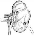 腎盂造瘺術 腎盂造瘺術