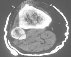 尤因肉瘤 尤因肉瘤
