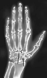 系統性澱粉樣變性