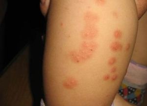丘疹性尋麻疹 丘疹性尋麻疹