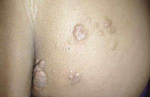 淺表脂肪瘤樣痣 淺表脂肪瘤樣痣