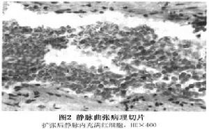 眼眶內靜脈曲張