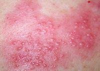 帶狀皰疹後遺神經痛