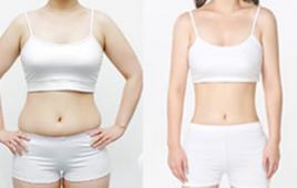 吸脂瘦腰 吸脂瘦腰