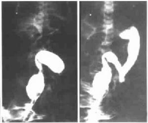 先天性巨結腸症