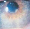 青光眼睫狀體炎綜合徵
