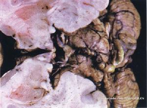 高血壓性腦出血