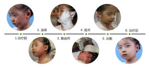 三維消融術祛胎記